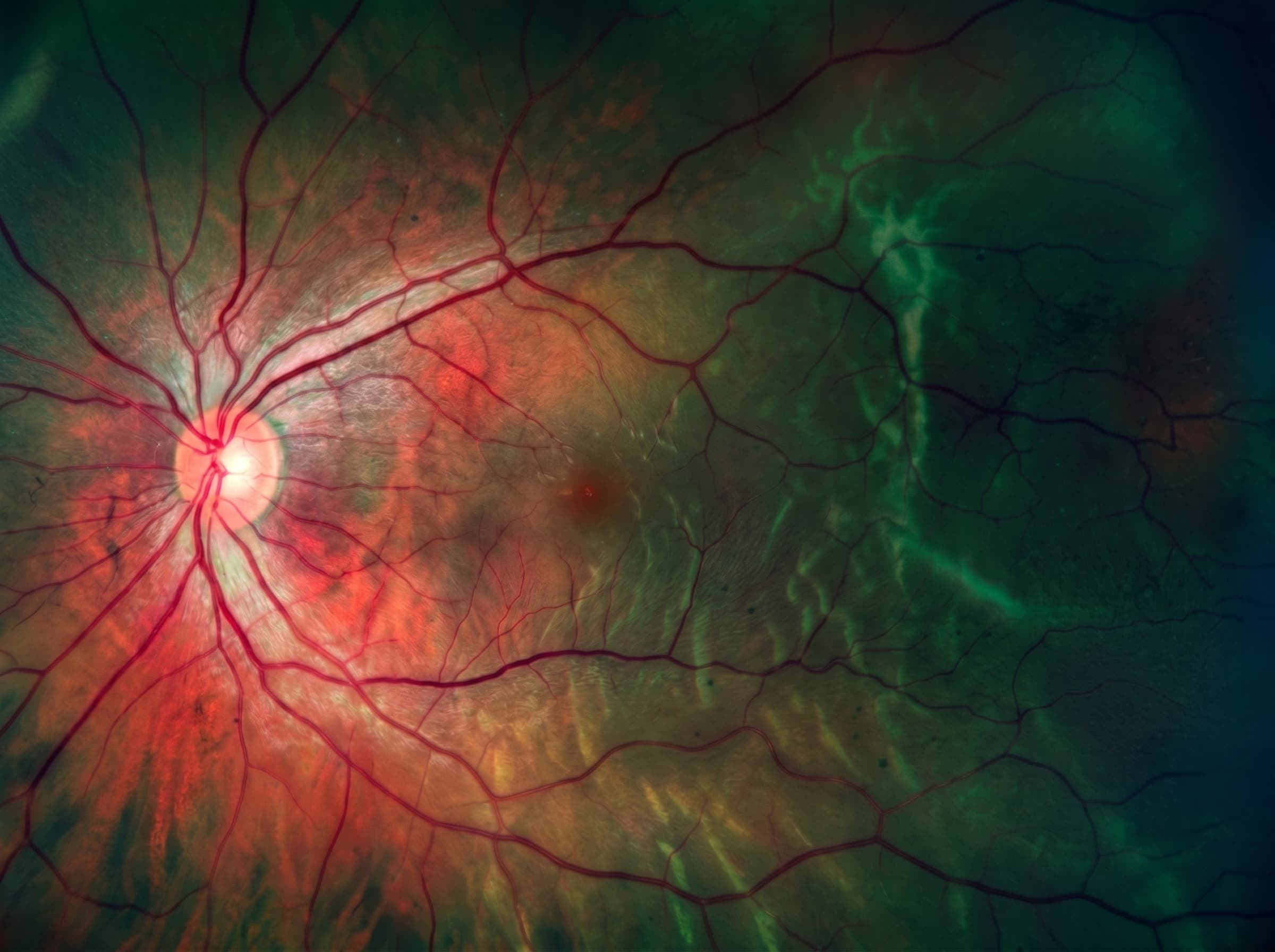 Retinal scan — Eye Conditions